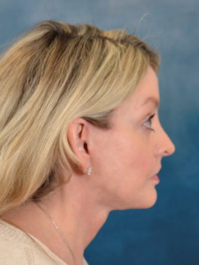 Brow Lift Before & After Gallery - Patient 217836 - Image 10