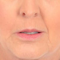 Lip Lift Before & After Gallery - Patient 268542 - Image 1