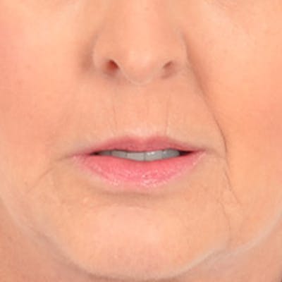 Lip Lift Before & After Gallery - Patient 268542 - Image 1