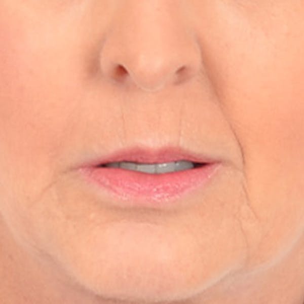 Lip Lift Before & After Gallery - Patient 268542 - Image 1