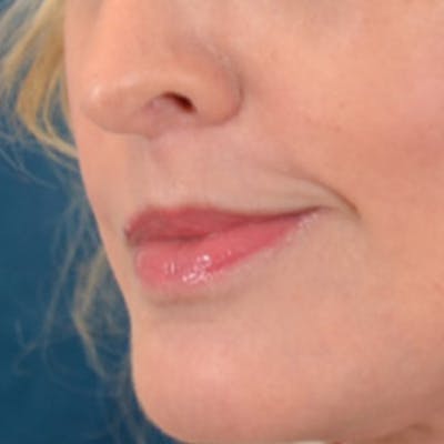 Lip Lift Before & After Gallery - Patient 268542 - Image 8