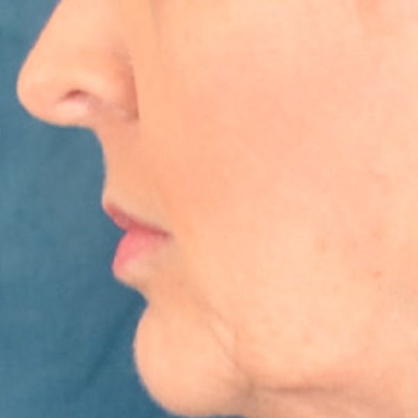 Lip Lift Before & After Gallery - Patient 268542 - Image 9