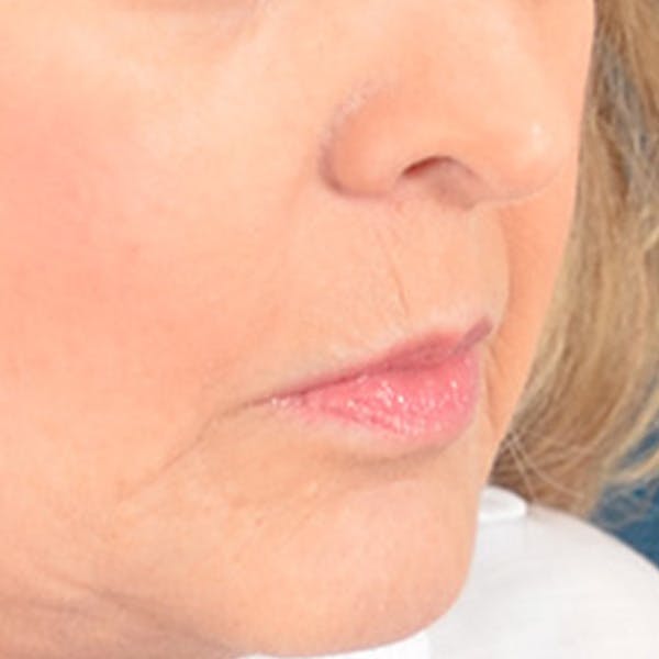 Lip Lift Before & After Gallery - Patient 268542 - Image 3