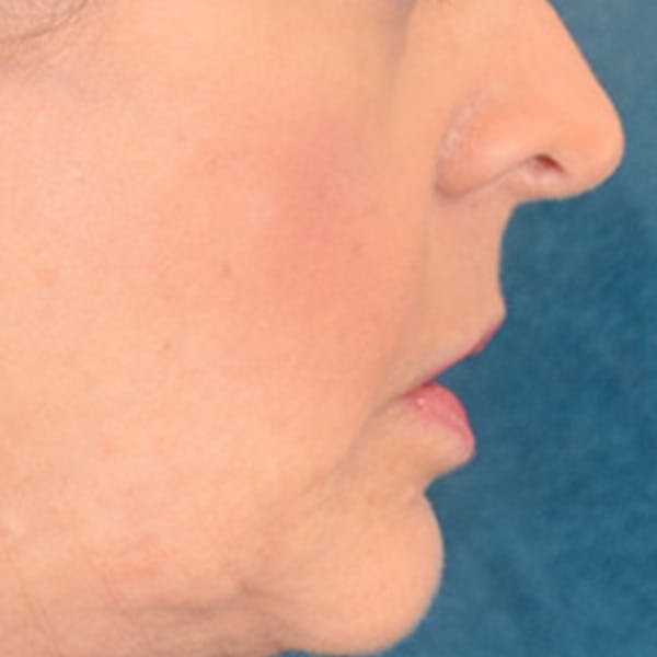 Lip Lift Before & After Gallery - Patient 268542 - Image 5
