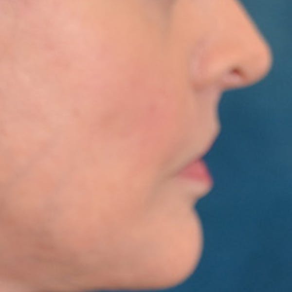 Lip Lift Before & After Gallery - Patient 268542 - Image 6