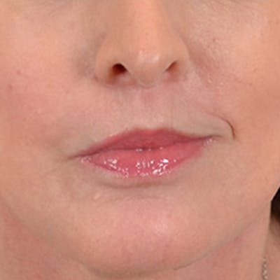 Lip Lift Before & After Gallery - Patient 268542 - Image 2