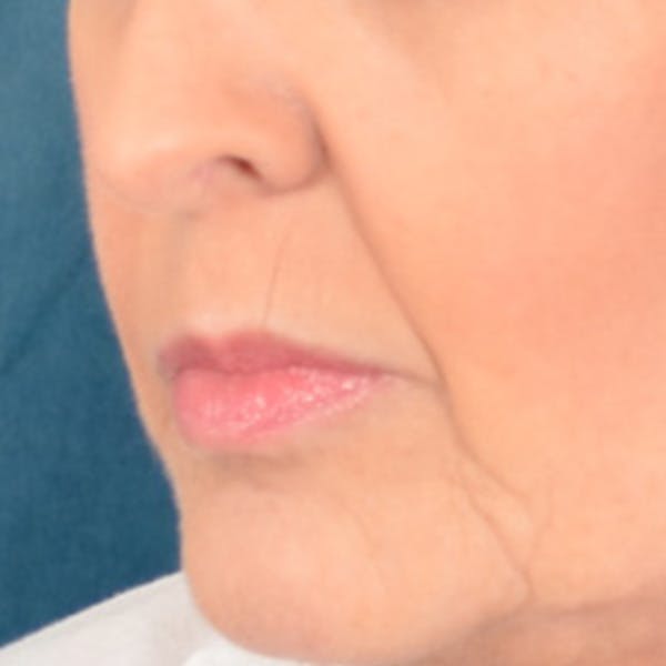 Lip Lift Before & After Gallery - Patient 268542 - Image 7