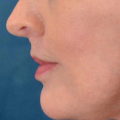 Lip Lift Before & After Gallery - Patient 268542 - Image 10