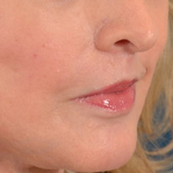 Lip Lift Before & After Gallery - Patient 268542 - Image 4