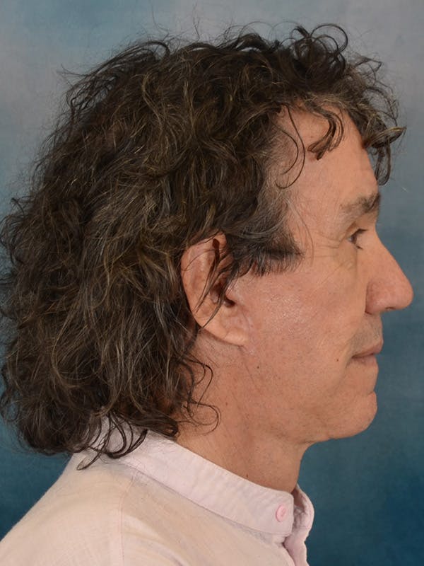 Brow Lift Before & After Gallery - Patient 266810 - Image 10
