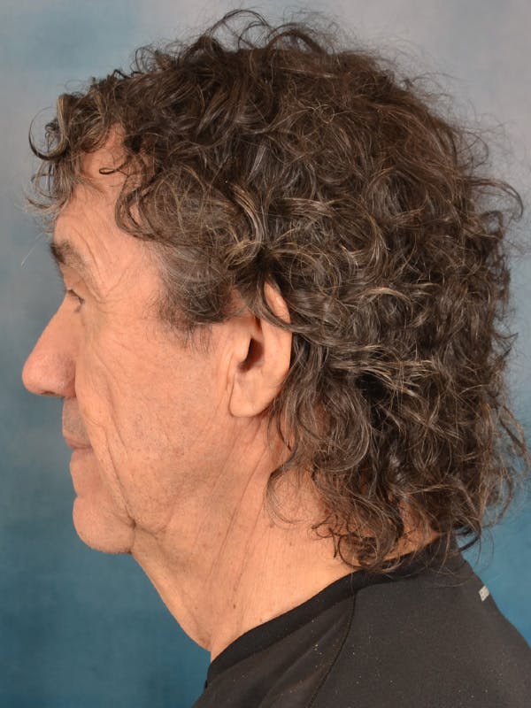 Brow Lift Before & After Gallery - Patient 266810 - Image 5