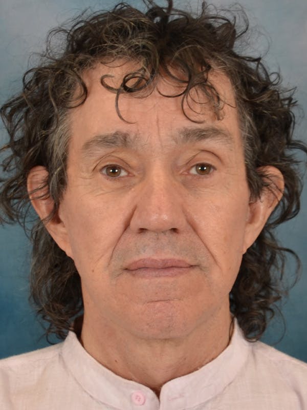 Brow Lift Before & After Gallery - Patient 266810 - Image 2