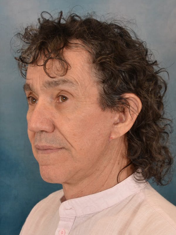 Brow Lift Before & After Gallery - Patient 266810 - Image 4