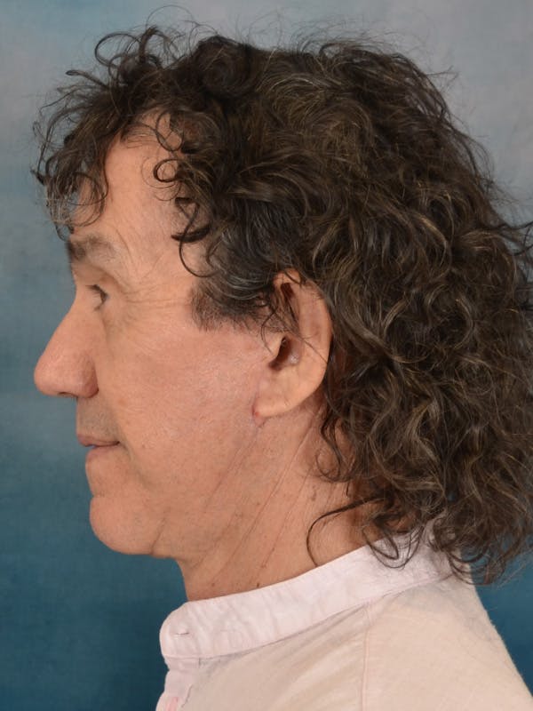 Brow Lift Before & After Gallery - Patient 266810 - Image 6