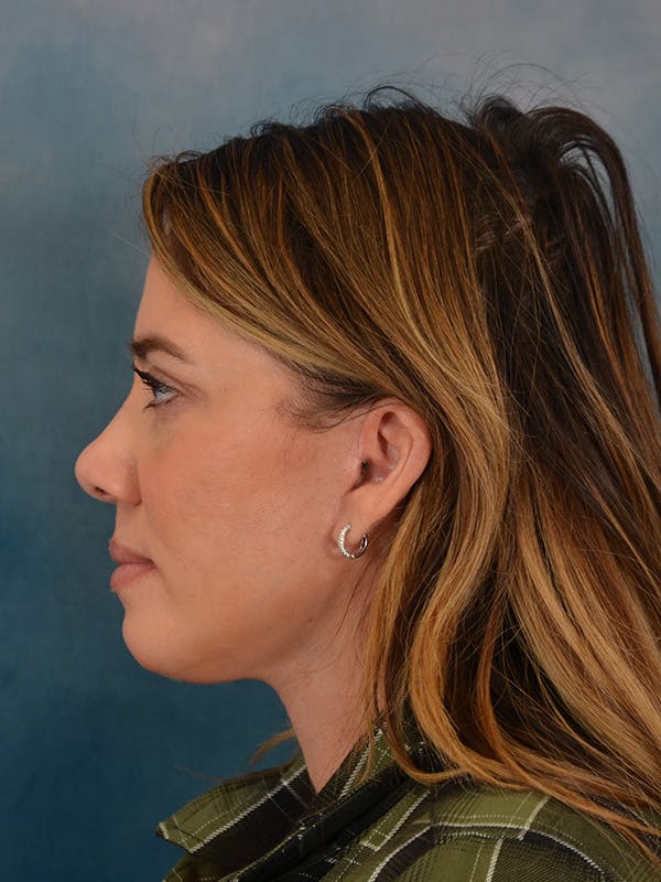 Deep Plane Facelift Before & After Gallery - Patient 309891 - Image 4