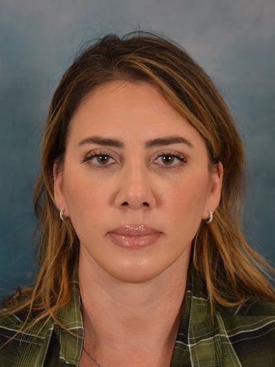 Deep Neck Lift Before & After Gallery - Patient 422842 - Image 2