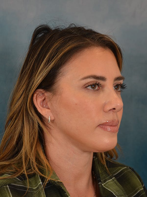 Deep Plane Facelift Before & After Gallery - Patient 309891 - Image 8
