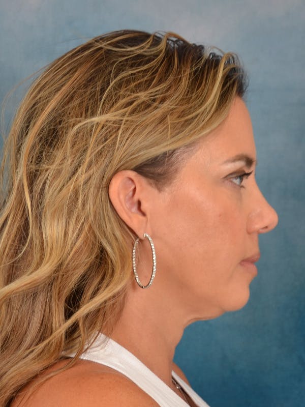 Deep Plane Facelift Before & After Gallery - Patient 309891 - Image 9