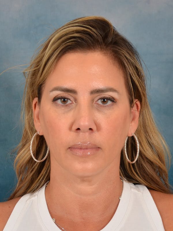 Deep Plane Facelift Before & After Gallery - Patient 309891 - Image 5