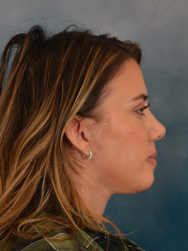 Deep Plane Facelift Before & After Gallery - Patient 309891 - Image 10