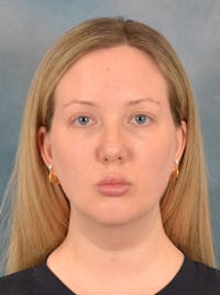 Deep Neck Lift Before & After Gallery - Patient 255788 - Image 1