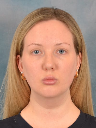 Deep Neck Lift Before & After Gallery - Patient 255788 - Image 1