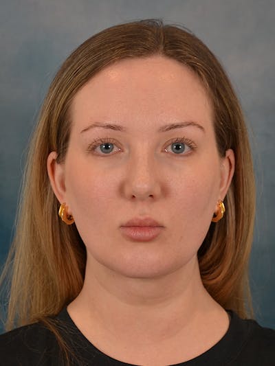 Deep Neck Lift Before & After Gallery - Patient 255788 - Image 2