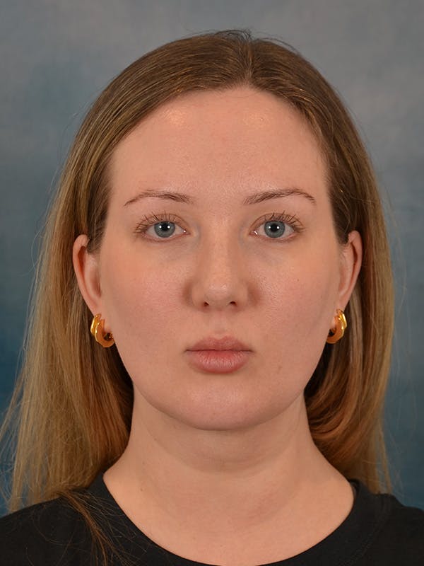 Deep Neck Lift Before & After Gallery - Patient 255788 - Image 2