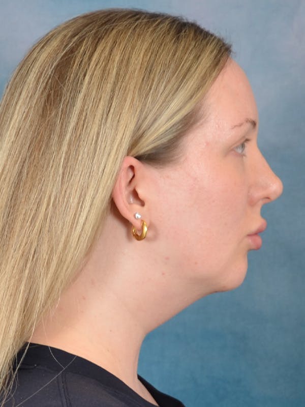 Deep Neck Lift Before & After Gallery - Patient 255788 - Image 9