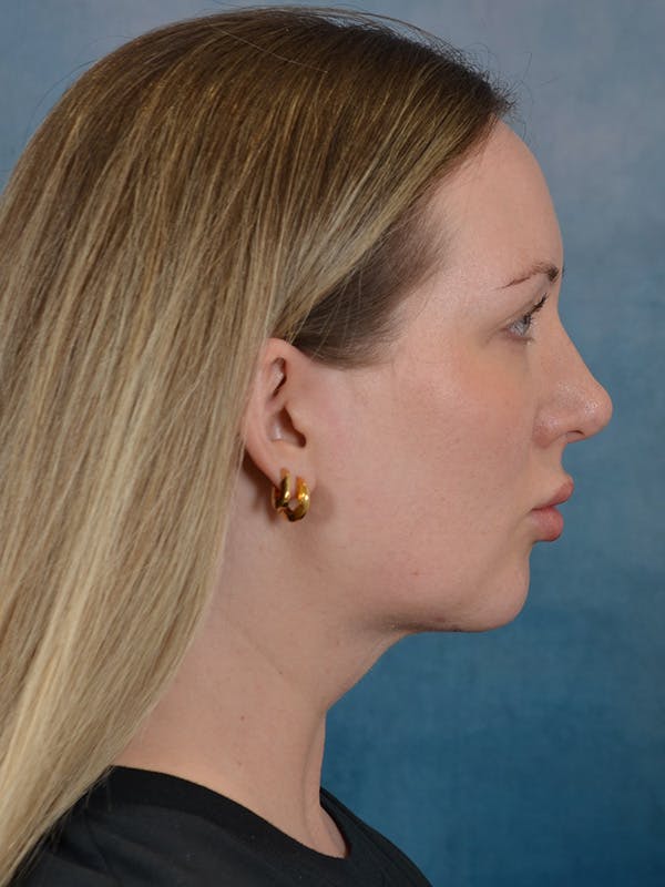 Deep Neck Lift Before & After Gallery - Patient 255788 - Image 10