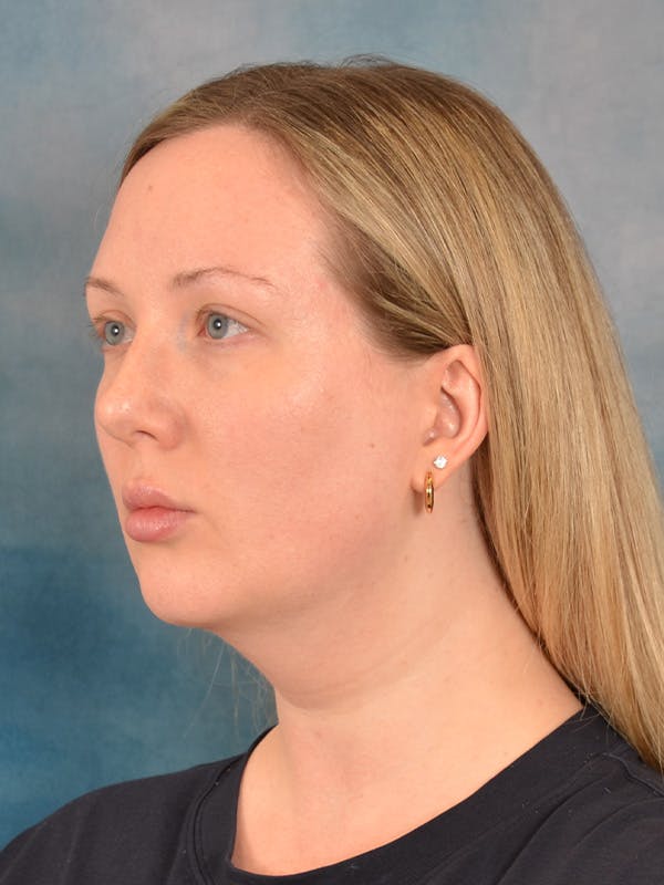 Deep Neck Lift Before & After Gallery - Patient 255788 - Image 3