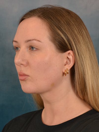 Deep Neck Lift Before & After Gallery - Patient 255788 - Image 4