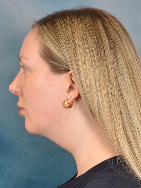 Deep Neck Lift Before & After Gallery - Patient 255788 - Image 5