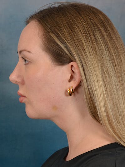 Deep Neck Lift Before & After Gallery - Patient 255788 - Image 6