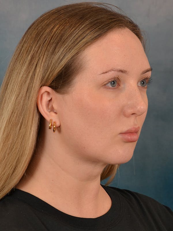 Deep Neck Lift Before & After Gallery - Patient 255788 - Image 8