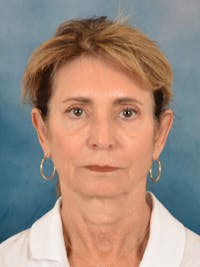 Brow Lift Before & After Gallery - Patient 448235 - Image 1