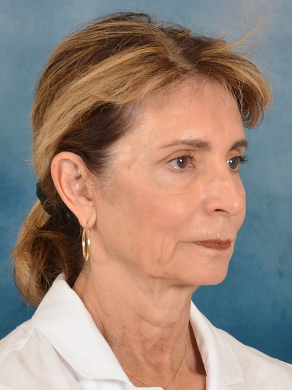 Brow Lift Before & After Gallery - Patient 448235 - Image 7