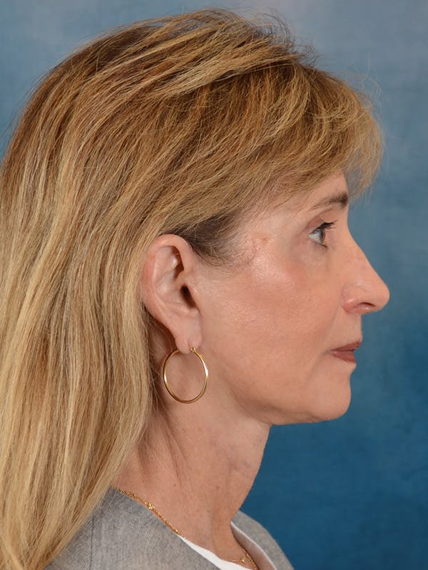 Brow Lift Before & After Gallery - Patient 448235 - Image 10