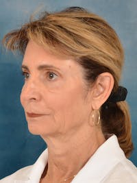 Deep Plane Facelift Before & After Gallery - Patient 210873 - Image 1