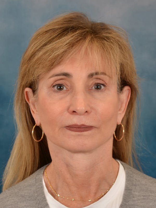 Brow Lift Before & After Gallery - Patient 448235 - Image 2