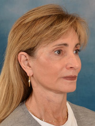 Brow Lift Before & After Gallery - Patient 448235 - Image 8