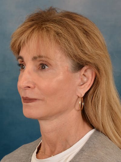 Brow Lift Before & After Gallery - Patient 448235 - Image 4