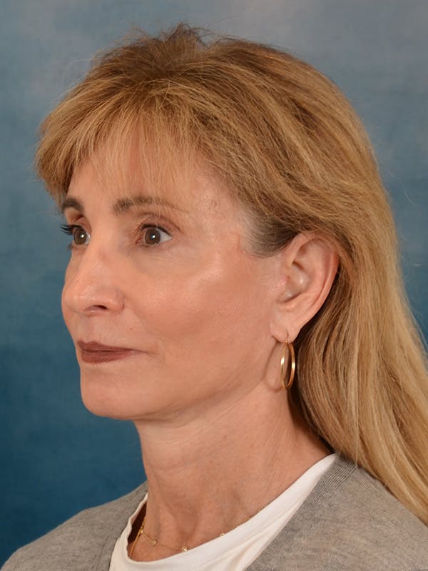 Brow Lift Before & After Gallery - Patient 448235 - Image 4