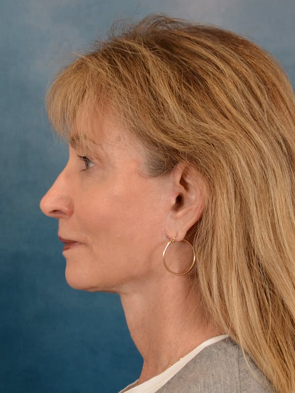 Brow Lift Before & After Gallery - Patient 448235 - Image 6