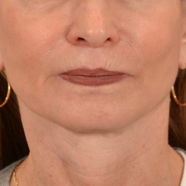 Lip Lift Before & After Gallery - Patient 218091 - Image 2