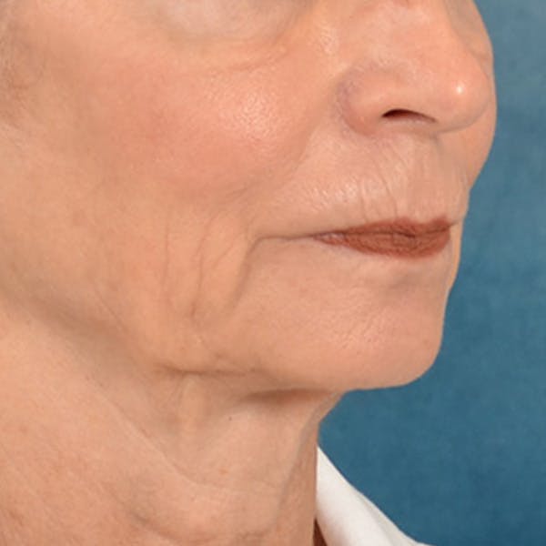 Lip Lift Before & After Gallery - Patient 218091 - Image 3