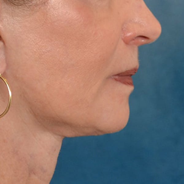 Lip Lift Before & After Gallery - Patient 218091 - Image 6