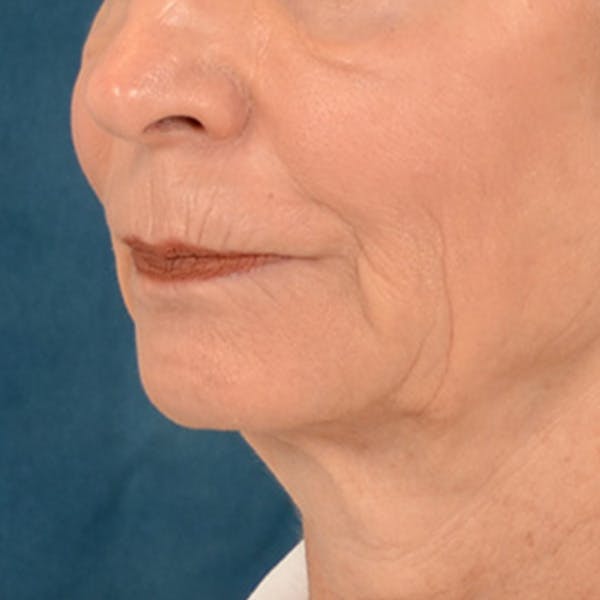 Lip Lift Before & After Gallery - Patient 218091 - Image 7