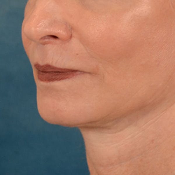 Lip Lift Before & After Gallery - Patient 218091 - Image 8