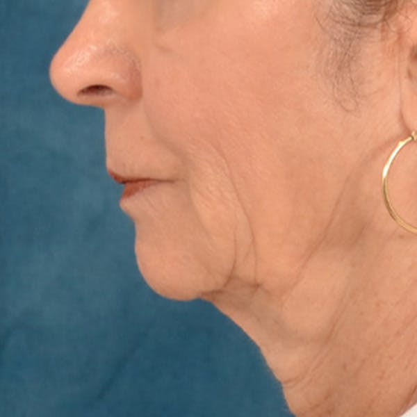 Lip Lift Before & After Gallery - Patient 218091 - Image 9